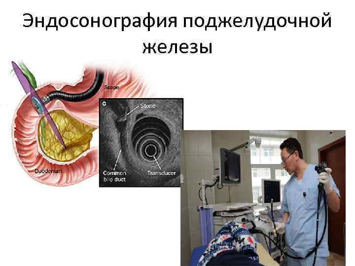Эндосонография поджелудочной железы 