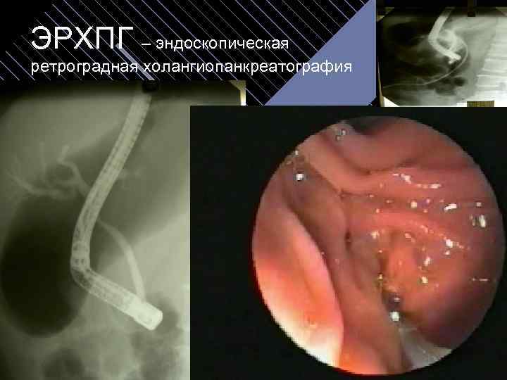 ЭРХПГ – эндоскопическая ретроградная холангиопанкреатография 