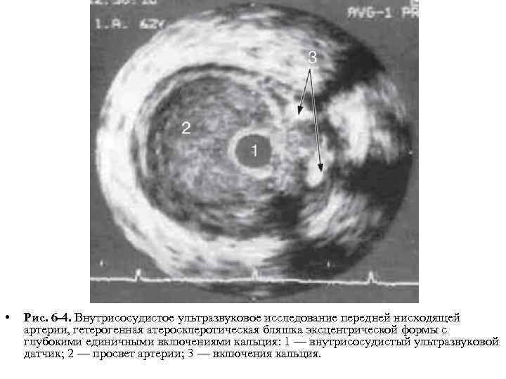  • Рис. 6 -4. Внутрисосудистое ультразвуковое исследование передней нисходящей артерии, гетерогенная атеросклеротическая бляшка