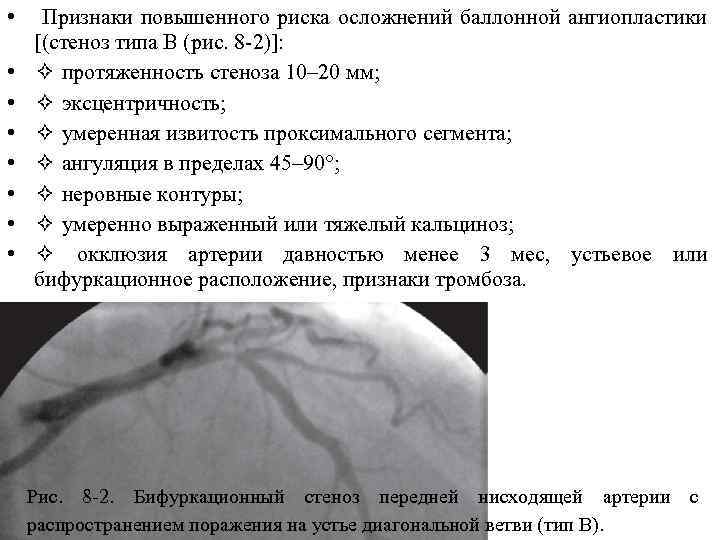  • • Признаки повышенного риска осложнений баллонной ангиопластики [(стеноз типа B (рис. 8