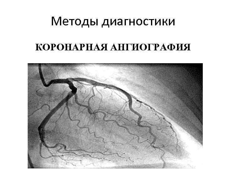 Методы диагностики КОРОНАРНАЯ АНГИОГРАФИЯ 