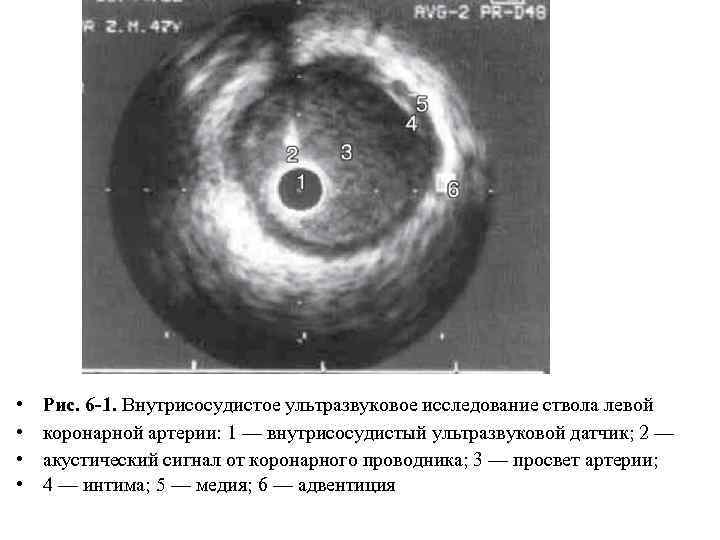  • • Рис. 6 -1. Внутрисосудистое ультразвуковое исследование ствола левой коронарной артерии: 1