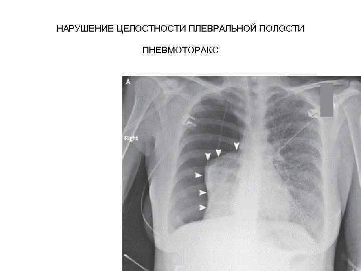 НАРУШЕНИЕ ЦЕЛОСТНОСТИ ПЛЕВРАЛЬНОЙ ПОЛОСТИ ПНЕВМОТОРАКС 