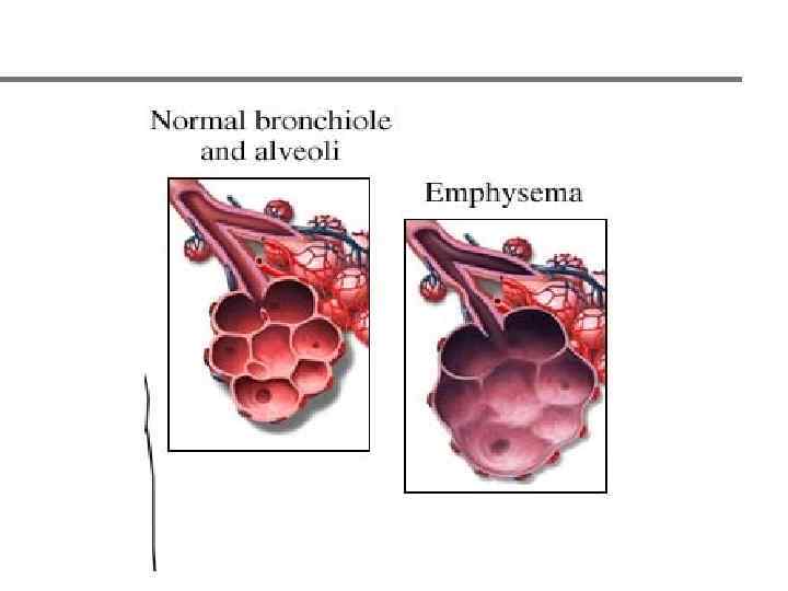 Нормальный ацинус vs. Эмфизема 