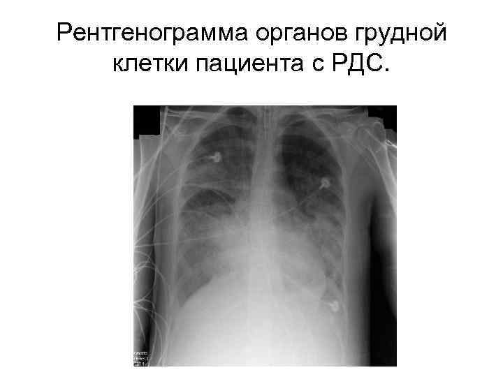 Рентгенограмма органов грудной клетки пациента с РДС. 