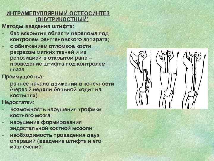 ИНТРАМЕДУЛЛЯРНЫЙ ОСТЕОСИНТЕЗ (ВНУТРИКОСТНЫЙ) Методы введения штифта: - без вскрытия области перелома под контролем рентгеновского