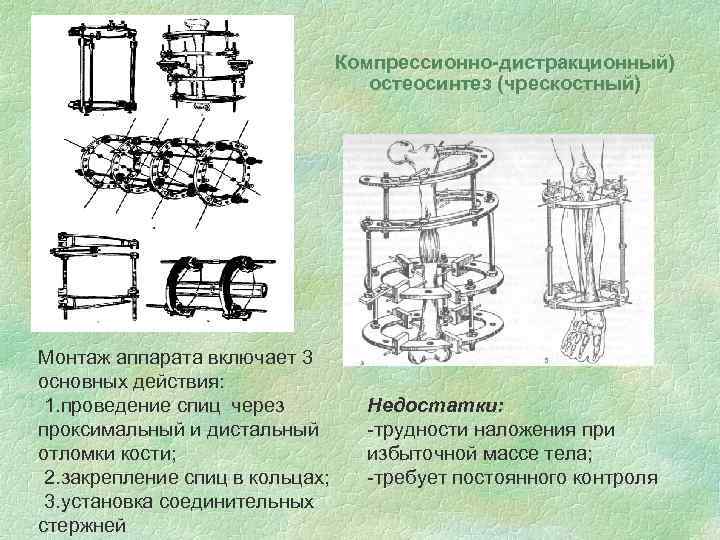 Компрессионно-дистракционный) остеосинтез (чрескостный) Монтаж аппарата включает 3 основных действия: 1. проведение спиц через проксимальный