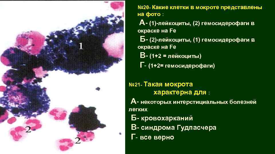 № 20 - Какие клетки в мокроте представлены на фото : А- (1)-лейкоциты, (2)