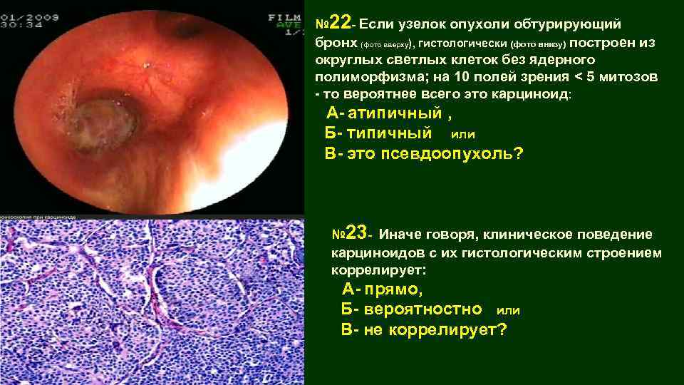 № 22 - Если узелок опухоли обтурирующий бронх (фото вверху), гистологически (фото внизу) построен