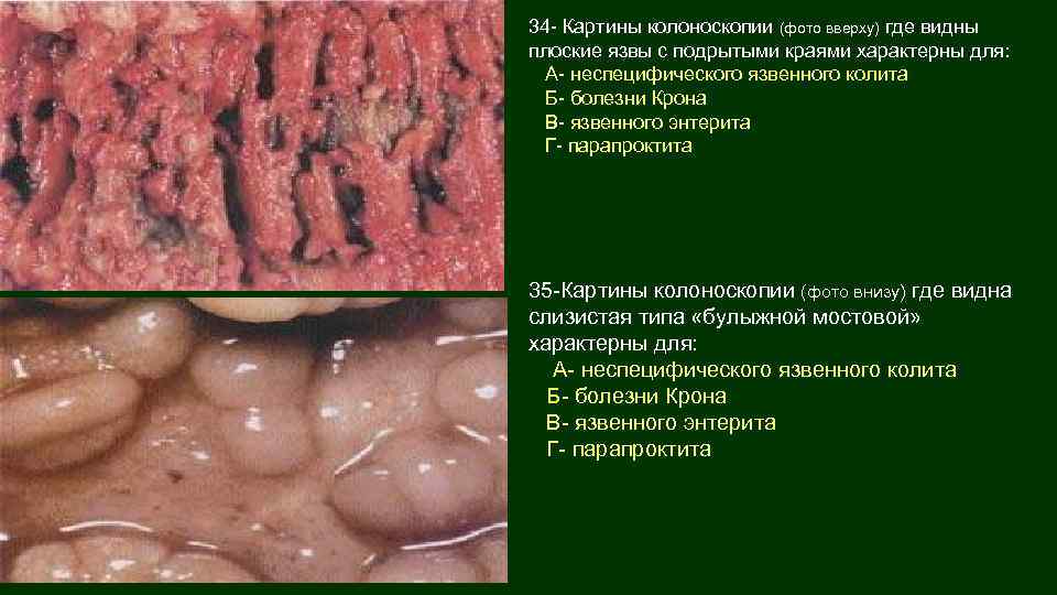 34 - Картины колоноскопии (фото вверху) где видны плоские язвы с подрытыми краями характерны