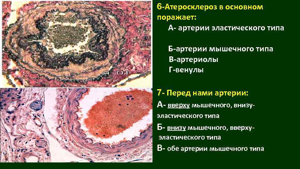 6 -Атеросклероз в основном поражает: А- артерии эластического типа Б-артерии мышечного типа В-артериолы Г-венулы