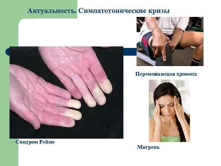 Актуальность. Симпатотонические кризы Перемежающая хромота Синдром Рейно Мигрень 