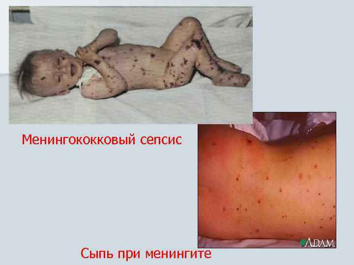 Менингококковый сепсис Сыпь при менингите 