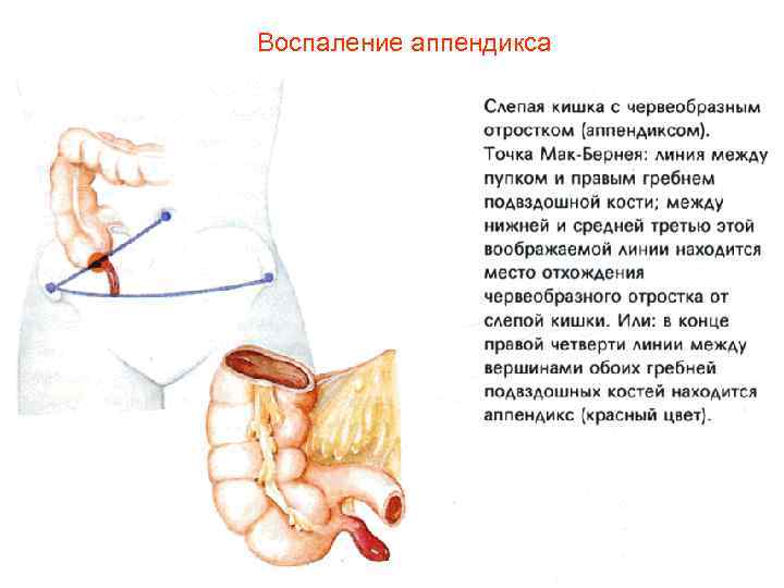 Воспаление аппендикса 