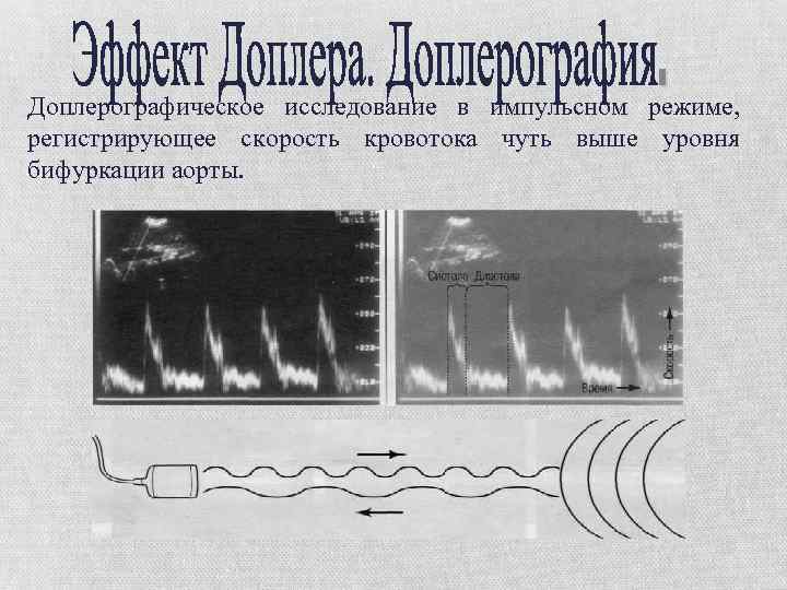 Доплерографическое исследование в импульсном режиме, регистрирующее скорость кровотока чуть выше уровня бифуркации аорты. 