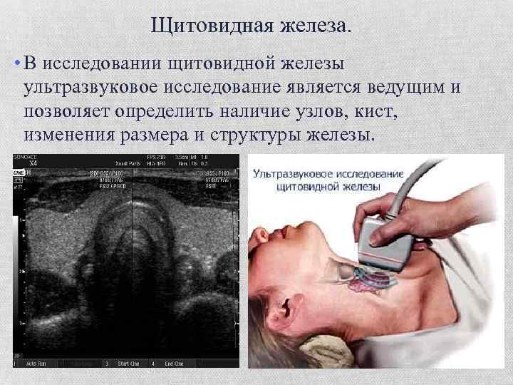 Щитовидная железа. • В исследовании щитовидной железы ультразвуковое исследование является ведущим и позволяет определить