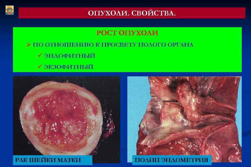 ОПУХОЛИ. СВОЙСТВА. РОСТ ОПУХОЛИ Ø ПО ОТНОШЕНИЮ К ПРОСВЕТУ ПОЛОГО ОРГАНА ü ЭНДОФИТНЫЙ ü