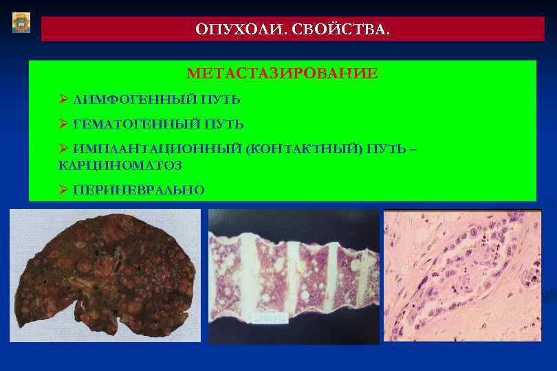 ОПУХОЛИ. СВОЙСТВА. МЕТАСТАЗИРОВАНИЕ Ø ЛИМФОГЕННЫЙ ПУТЬ Ø ГЕМАТОГЕННЫЙ ПУТЬ Ø ИМПЛАНТАЦИОННЫЙ (КОНТАКТНЫЙ) ПУТЬ –