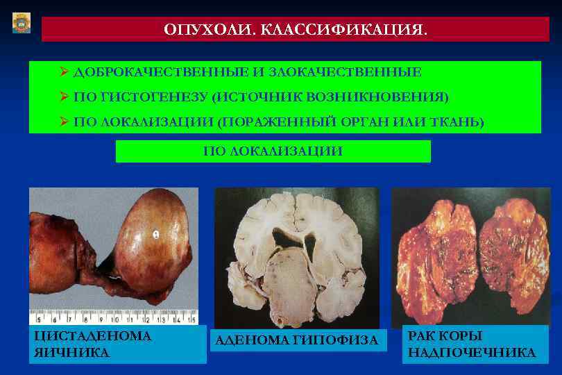 ОПУХОЛИ. КЛАССИФИКАЦИЯ. Ø ДОБРОКАЧЕСТВЕННЫЕ И ЗЛОКАЧЕСТВЕННЫЕ Ø ПО ГИСТОГЕНЕЗУ (ИСТОЧНИК ВОЗНИКНОВЕНИЯ) Ø ПО ЛОКАЛИЗАЦИИ