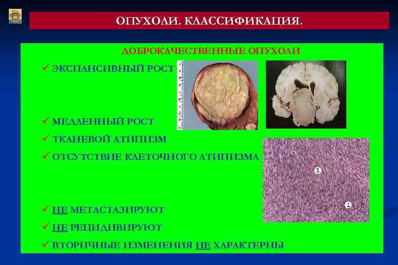 Доброкачественная ткань. Экспансивный рост опухоли. Экспансивный рост доброкачественных опухолей. Ээкспульсивный рост опухоли. Для злокачественной опухоли характерен рост экспансивный.