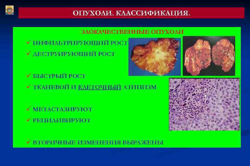 ОПУХОЛИ. КЛАССИФИКАЦИЯ. ЗЛОКАЧЕСТВЕННЫЕ ОПУХОЛИ ü ИНФИЛЬТРИРУЮЩИЙ РОСТ ü ДЕСТРУИРУЮЩИЙ РОСТ ü БЫСТРЫЙ РОСТ ü