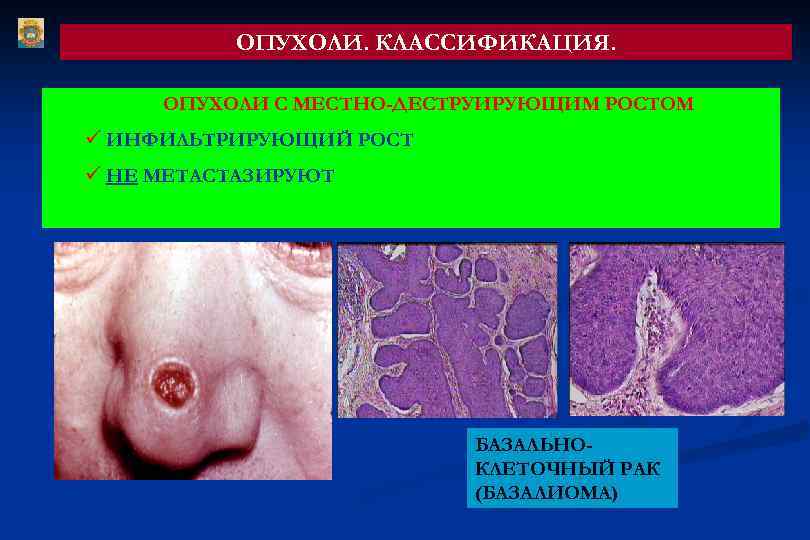 ОПУХОЛИ. КЛАССИФИКАЦИЯ. ОПУХОЛИ С МЕСТНО-ДЕСТРУИРУЮЩИМ РОСТОМ ü ИНФИЛЬТРИРУЮЩИЙ РОСТ ü НЕ МЕТАСТАЗИРУЮТ БАЗАЛЬНОКЛЕТОЧНЫЙ РАК