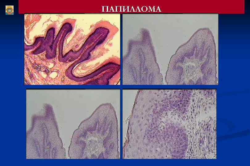 ПАПИЛЛОМА 