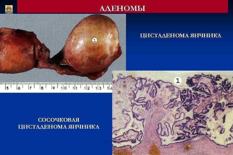 АДЕНОМЫ ЦИСТАДЕНОМА ЯИЧНИКА СОСОЧКОВАЯ ЦИСТАДЕНОМА ЯИЧНИКА 