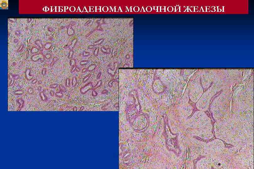 Фиброаденомы молочных желез. Фиброаденома молочной железы микропрепарат. Фиброаденома молочной железы Патан. Фиброаденома молочной железы гистология. Фиброаденома молочной железы препарат.