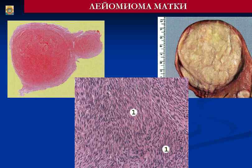ЛЕЙОМИОМА МАТКИ 