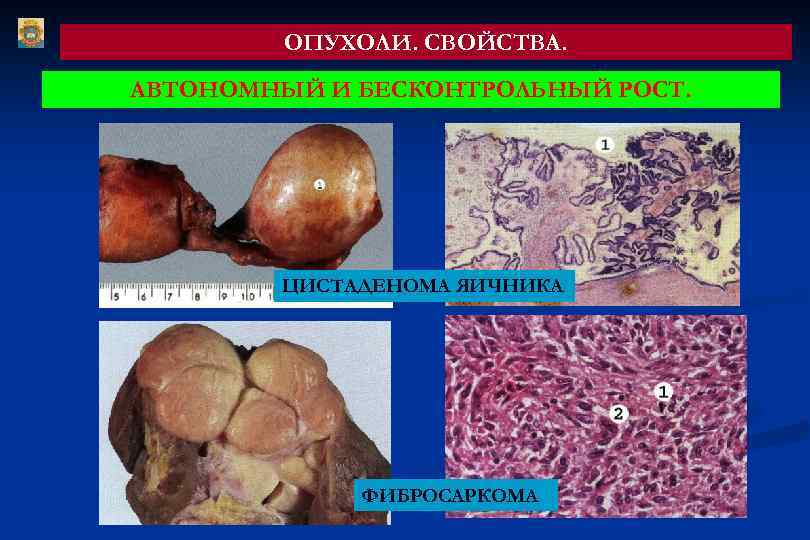 ОПУХОЛИ. СВОЙСТВА. АВТОНОМНЫЙ И БЕСКОНТРОЛЬНЫЙ РОСТ. ЦИСТАДЕНОМА ЯИЧНИКА ФИБРОСАРКОМА 