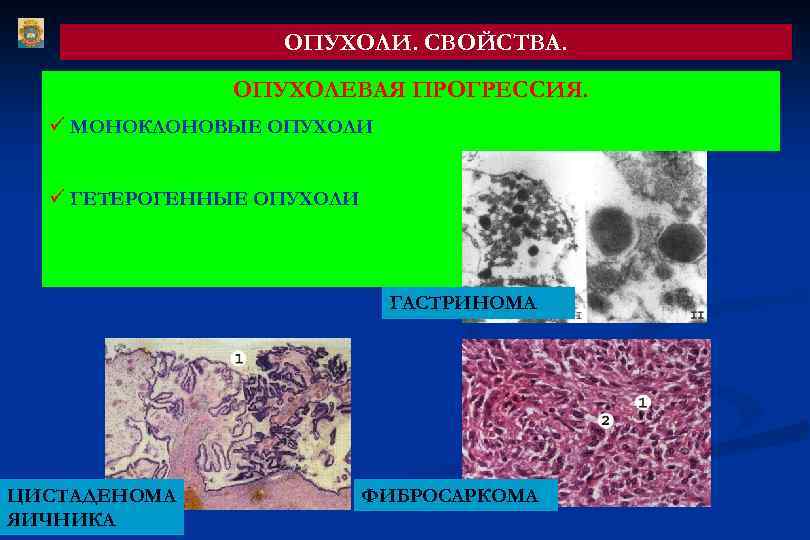 ОПУХОЛИ. СВОЙСТВА. ОПУХОЛЕВАЯ ПРОГРЕССИЯ. ü МОНОКЛОНОВЫЕ ОПУХОЛИ ü ГЕТЕРОГЕННЫЕ ОПУХОЛИ ГАСТРИНОМА ЦИСТАДЕНОМА ЯИЧНИКА ФИБРОСАРКОМА