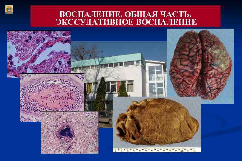 ВОСПАЛЕНИЕ. ОБЩАЯ ЧАСТЬ. ЭКССУДАТИВНОЕ ВОСПАЛЕНИЕ 