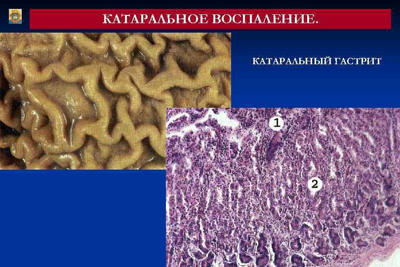КАТАРАЛЬНОЕ ВОСПАЛЕНИЕ. КАТАРАЛЬНЫЙ ГАСТРИТ 