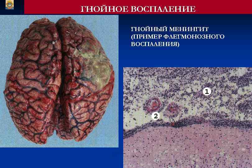 ГНОЙНОЕ ВОСПАЛЕНИЕ ГНОЙНЫЙ МЕНИНГИТ (ПРИМЕР ФЛЕГМОНОЗНОГО ВОСПАЛЕНИЯ) 