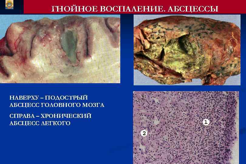 ГНОЙНОЕ ВОСПАЛЕНИЕ. АБСЦЕССЫ НАВЕРХУ – ПОДОСТРЫЙ АБСЦЕСС ГОЛОВНОГО МОЗГА СПРАВА – ХРОНИЧЕСКИЙ АБСЦЕСС ЛЕГКОГО