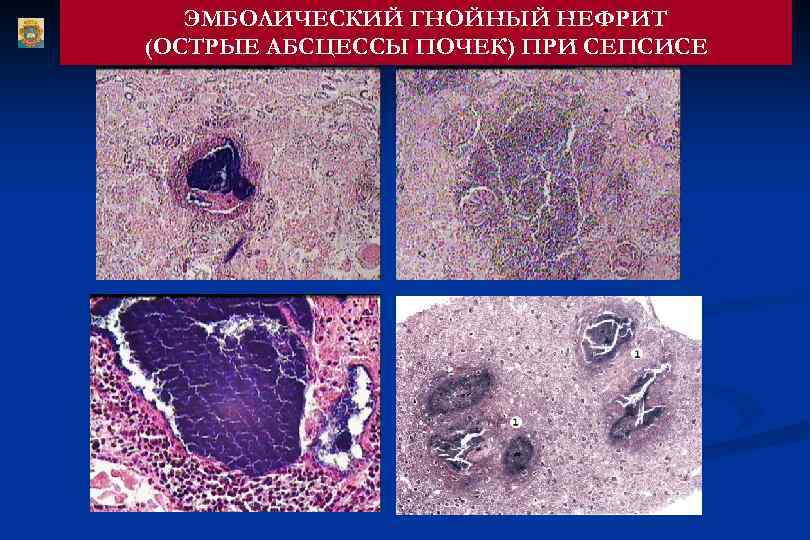 ЭМБОЛИЧЕСКИЙ ГНОЙНЫЙ НЕФРИТ (ОСТРЫЕ АБСЦЕССЫ ПОЧЕК) ПРИ СЕПСИСЕ 