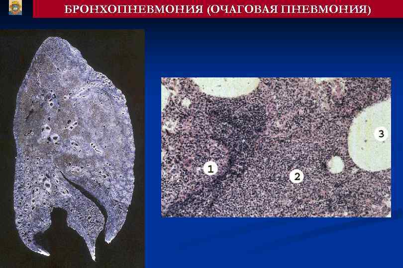 БРОНХОПНЕВМОНИЯ (ОЧАГОВАЯ ПНЕВМОНИЯ) 