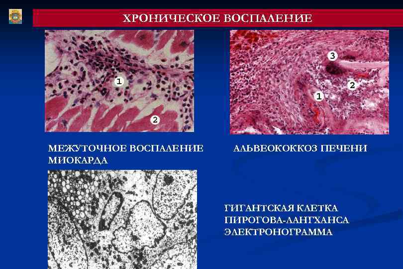 ХРОНИЧЕСКОЕ ВОСПАЛЕНИЕ МЕЖУТОЧНОЕ ВОСПАЛЕНИЕ МИОКАРДА АЛЬВЕОКОККОЗ ПЕЧЕНИ ГИГАНТСКАЯ КЛЕТКА ПИРОГОВА-ЛАНГХАНСА ЭЛЕКТРОНОГРАММА 