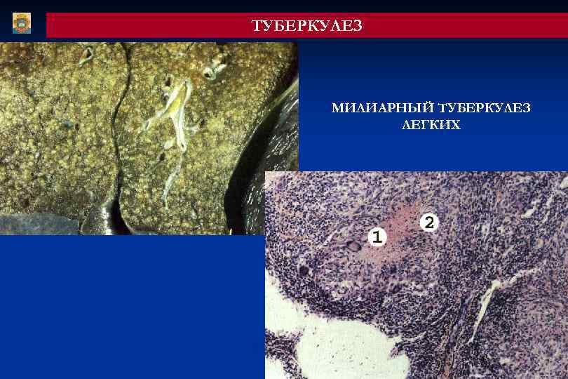 ТУБЕРКУЛЕЗ МИЛИАРНЫЙ ТУБЕРКУЛЕЗ ЛЕГКИХ 