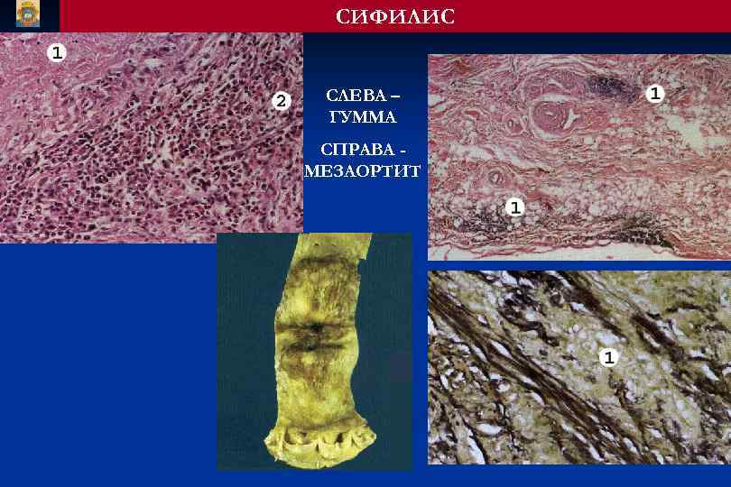 СИФИЛИС СЛЕВА – ГУММА СПРАВА МЕЗАОРТИТ 