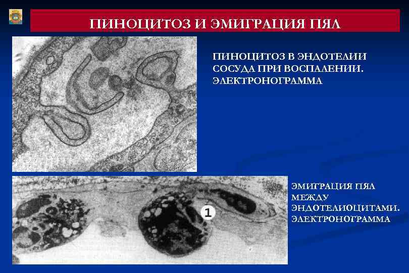 Экссудативное воспаление схема