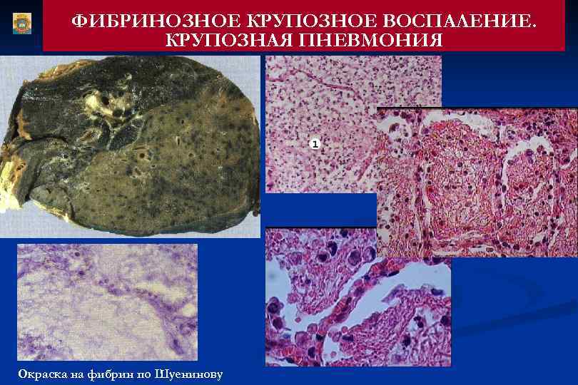 ФИБРИНОЗНОЕ КРУПОЗНОЕ ВОСПАЛЕНИЕ. КРУПОЗНАЯ ПНЕВМОНИЯ Окраска на фибрин по Шуенинову 