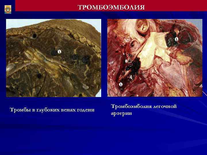 ТРОМБОЭМБОЛИЯ Тромбы в глубоких венах годени Тромбоэмболия легочной артерии 