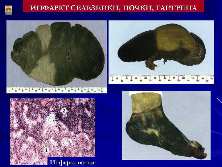 ИНФАРКТ СЕЛЕЗЕНКИ, ПОЧКИ, ГАНГРЕНА Инфаркт почки 
