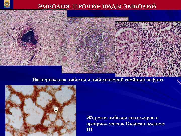 ЭМБОЛИЯ. ПРОЧИЕ ВИДЫ ЭМБОЛИЙ Бактериальная эмболия и эмболический гнойный нефрит Жировая эмболия капилляров и