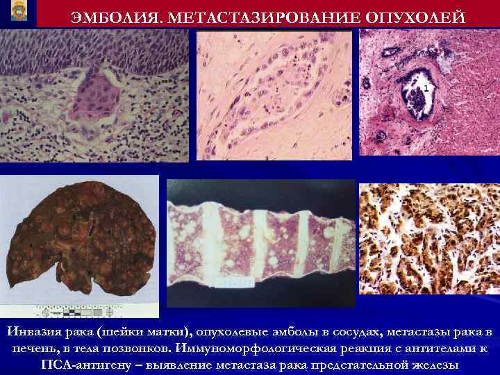 ЭМБОЛИЯ. МЕТАСТАЗИРОВАНИЕ ОПУХОЛЕЙ Инвазия рака (шейки матки), опухолевые эмболы в сосудах, метастазы рака в