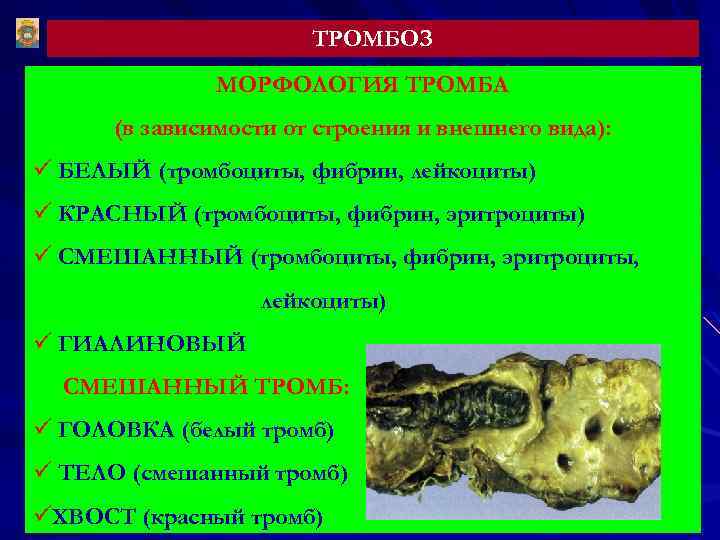 ТРОМБОЗ МОРФОЛОГИЯ ТРОМБА (в зависимости от строения и внешнего вида): ü БЕЛЫЙ (тромбоциты, фибрин,