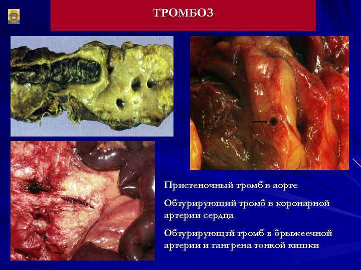 ТРОМБОЗ Пристеночный тромб в аорте Обтурирующий тромб в коронарной артерии сердца Обтурирующтй тромб в