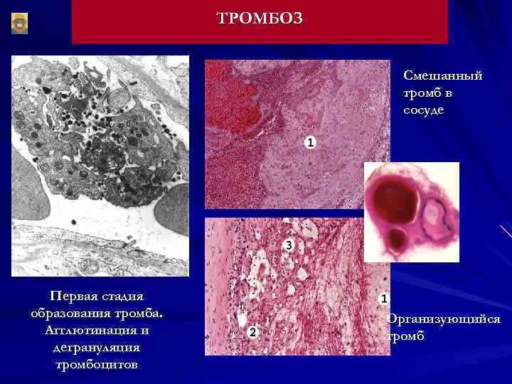 ТРОМБОЗ Смешанный тромб в сосуде Первая стадия образования тромба. Агглютинация и дегрануляция тромбоцитов Организующийся